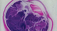 Blasting Retinoblastoma