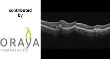 Real World Clinical Outcomes: Wet AMD, 81-year-old male