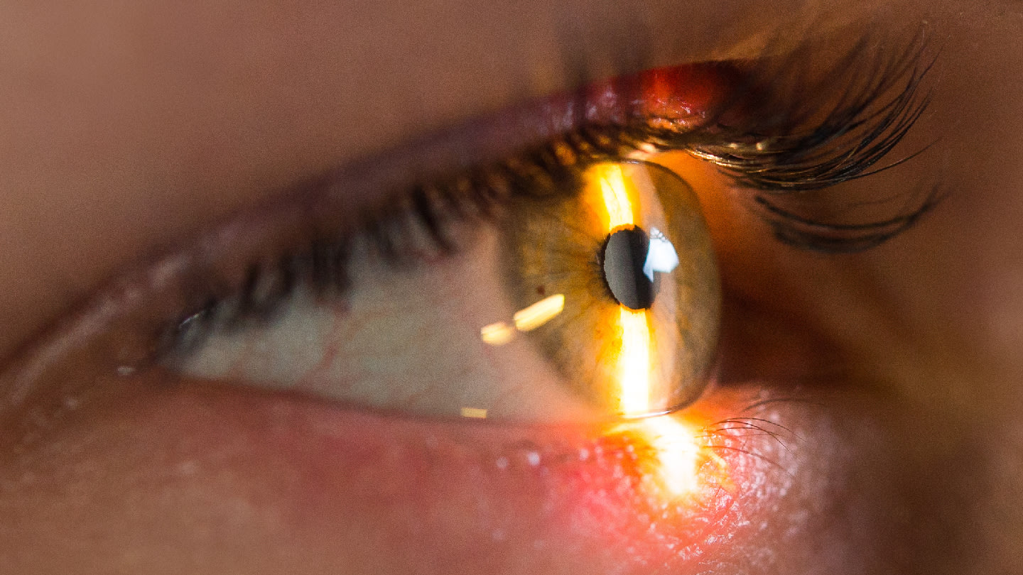 Expanding the Therapeutic Landscape in Wet Agerelated Macular Degeneration