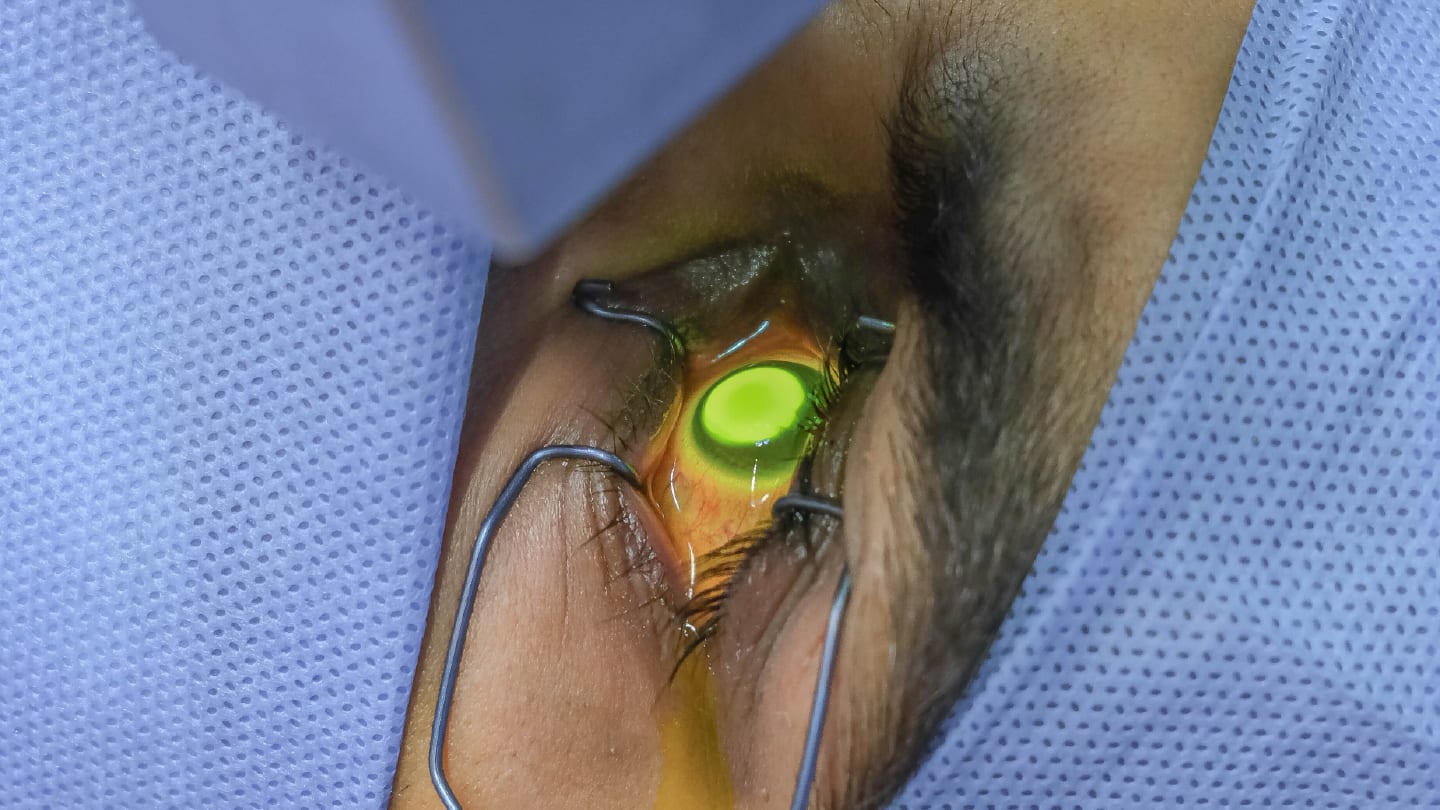 Personalizing Corneal Cross-Linking