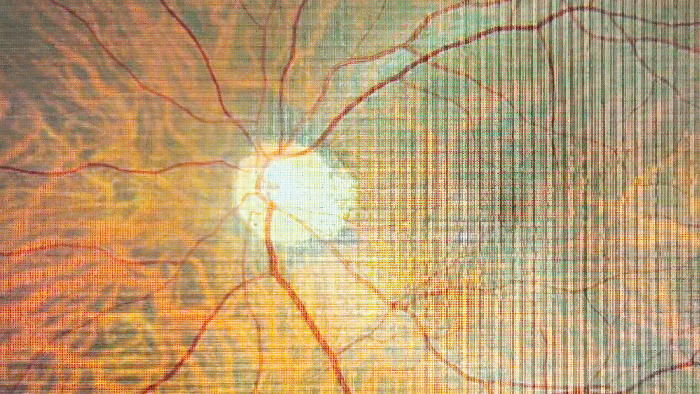 Sandoz Launches Aflibercept Biosimilar in Europe