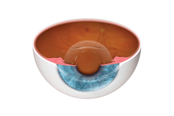 EVO ICL – Expanding Refractive Surgery Options