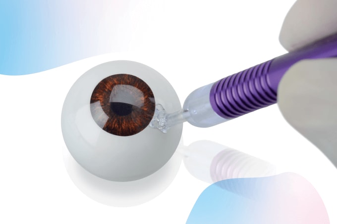 MicroPulse P3® Delivery Device for Non-Incisional Glaucoma Treatment