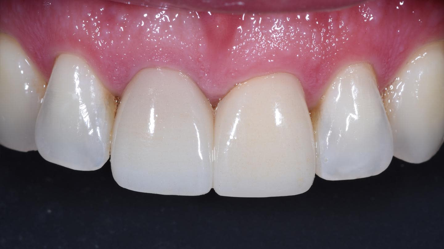 Final result with 5Y zirconia crowns.
