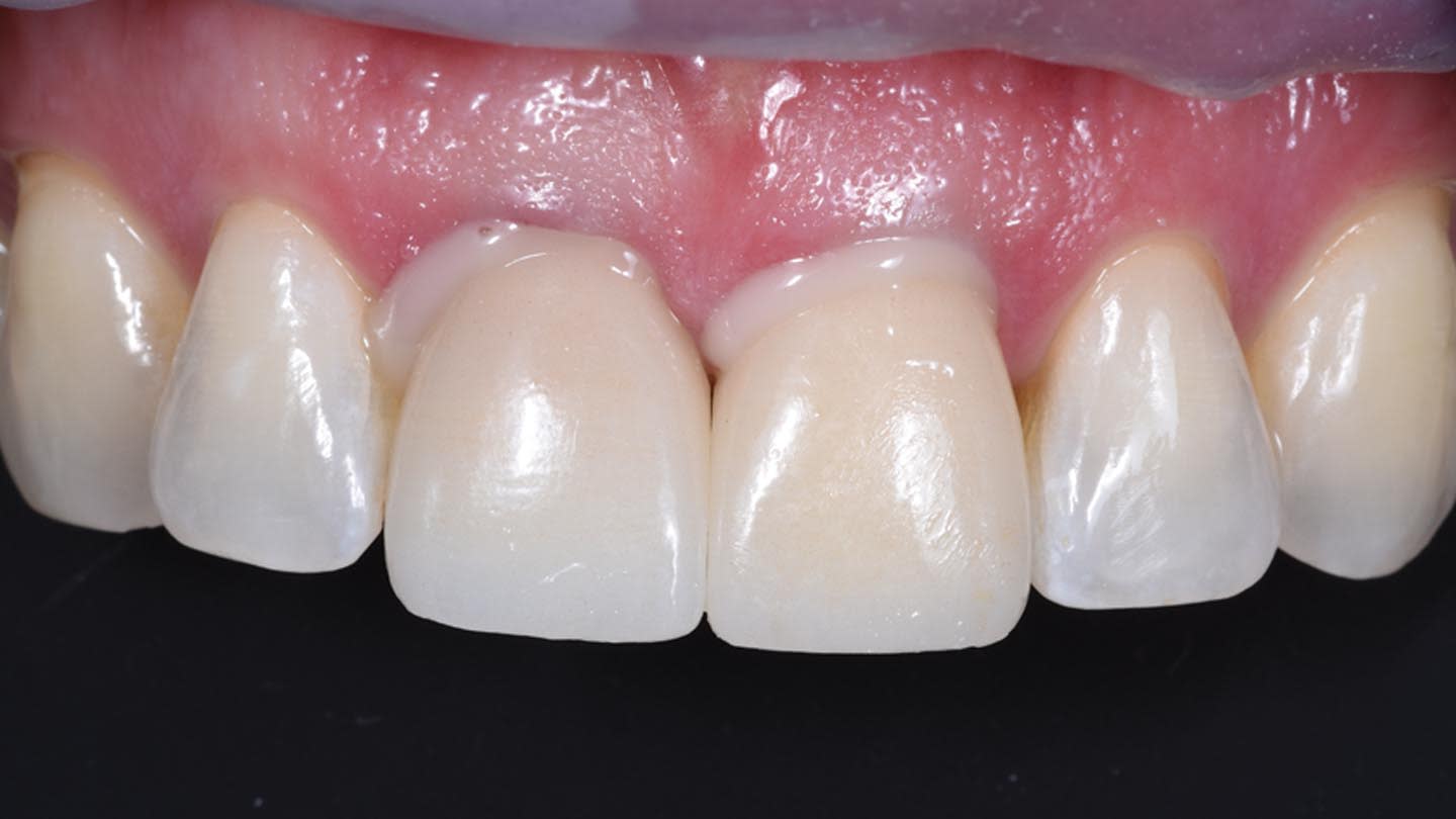 Cementation with BeautiLink SA following crown preparations.