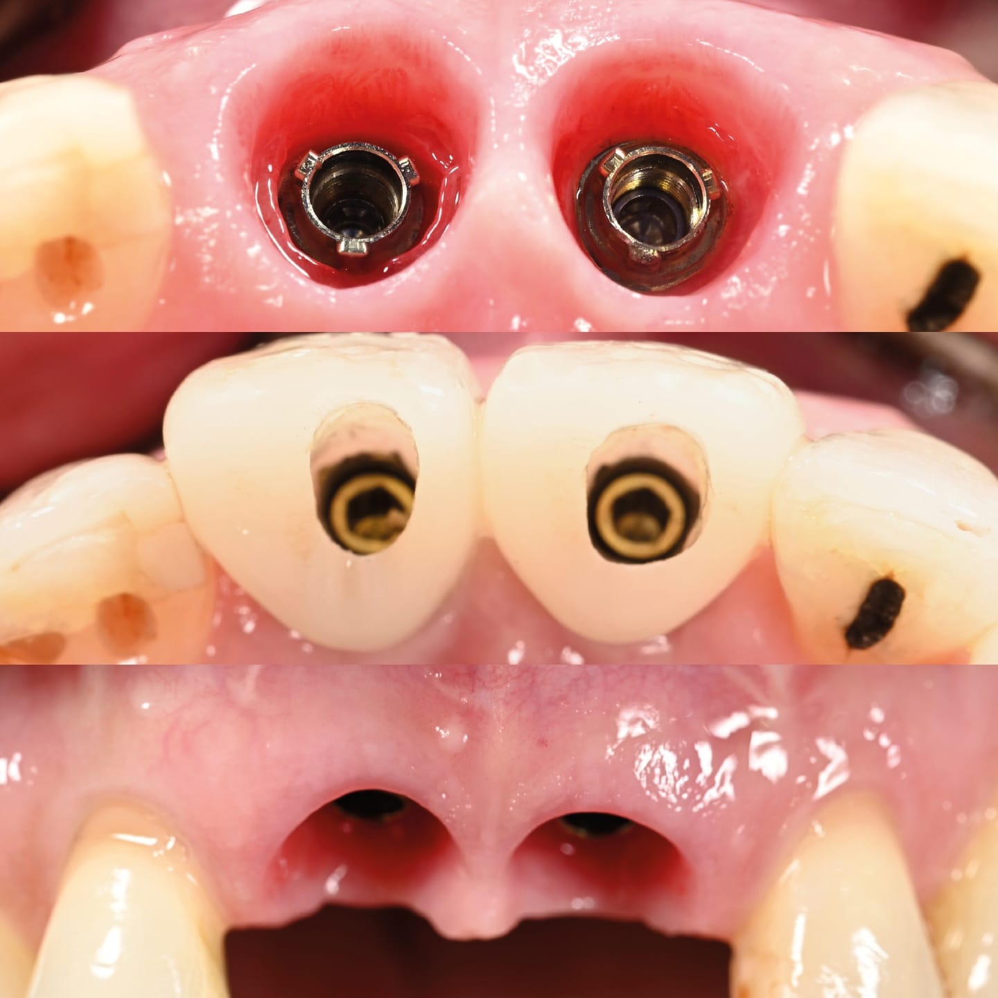 Temporary Restoration