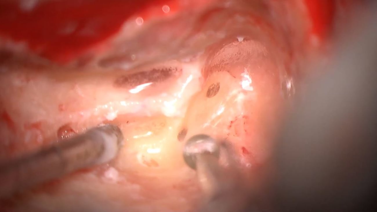 Mount Sinai Otolaryngology Surgical Series: Meniere’s Disease: Labyrinthectomy