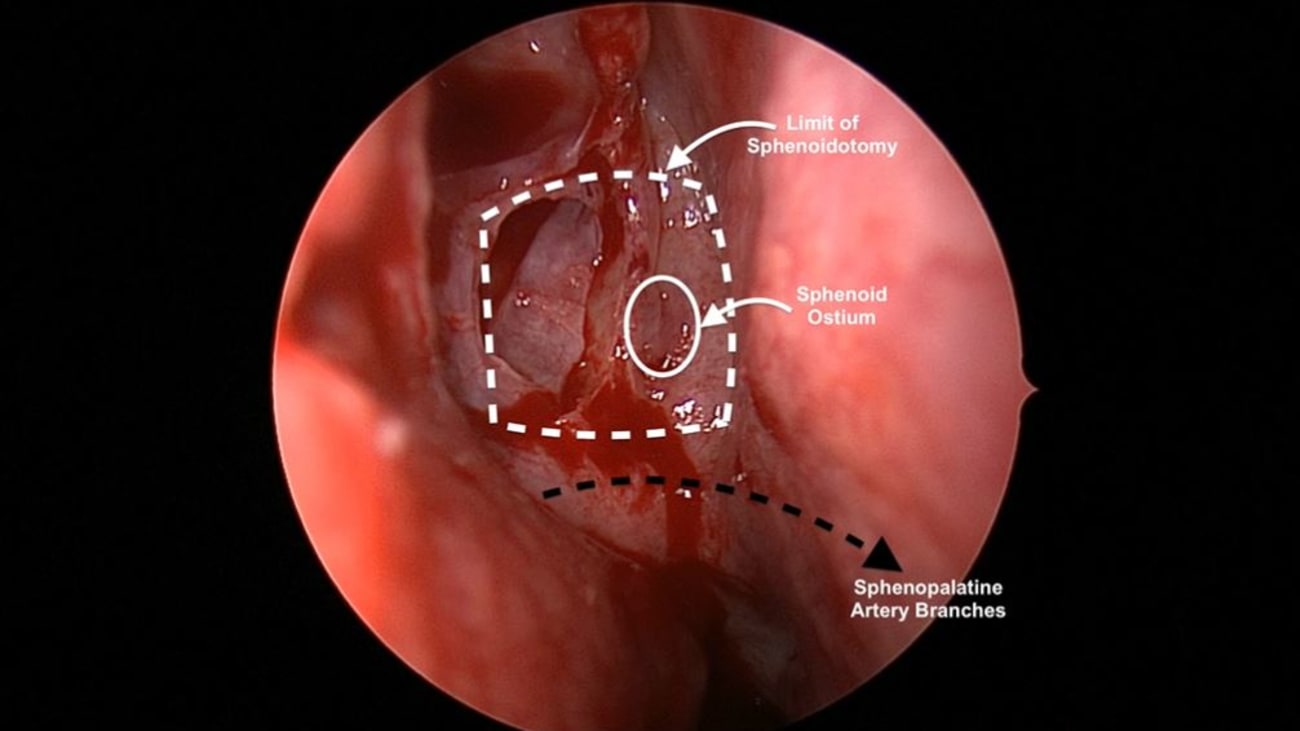 Mount Sinai Otolaryngology Surgical Series: Sinus Fungus Ball (Sphenoid Mycetoma) Removal