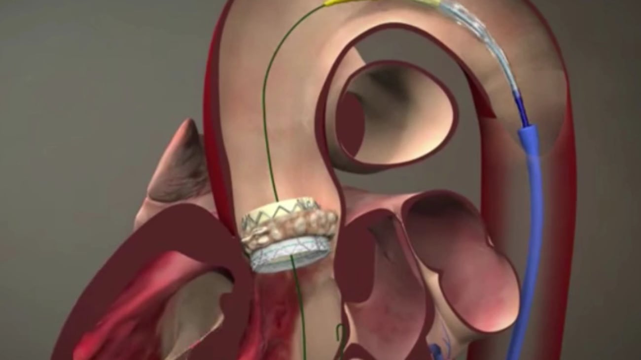 Clinical Minutes: Structural Heart Disease