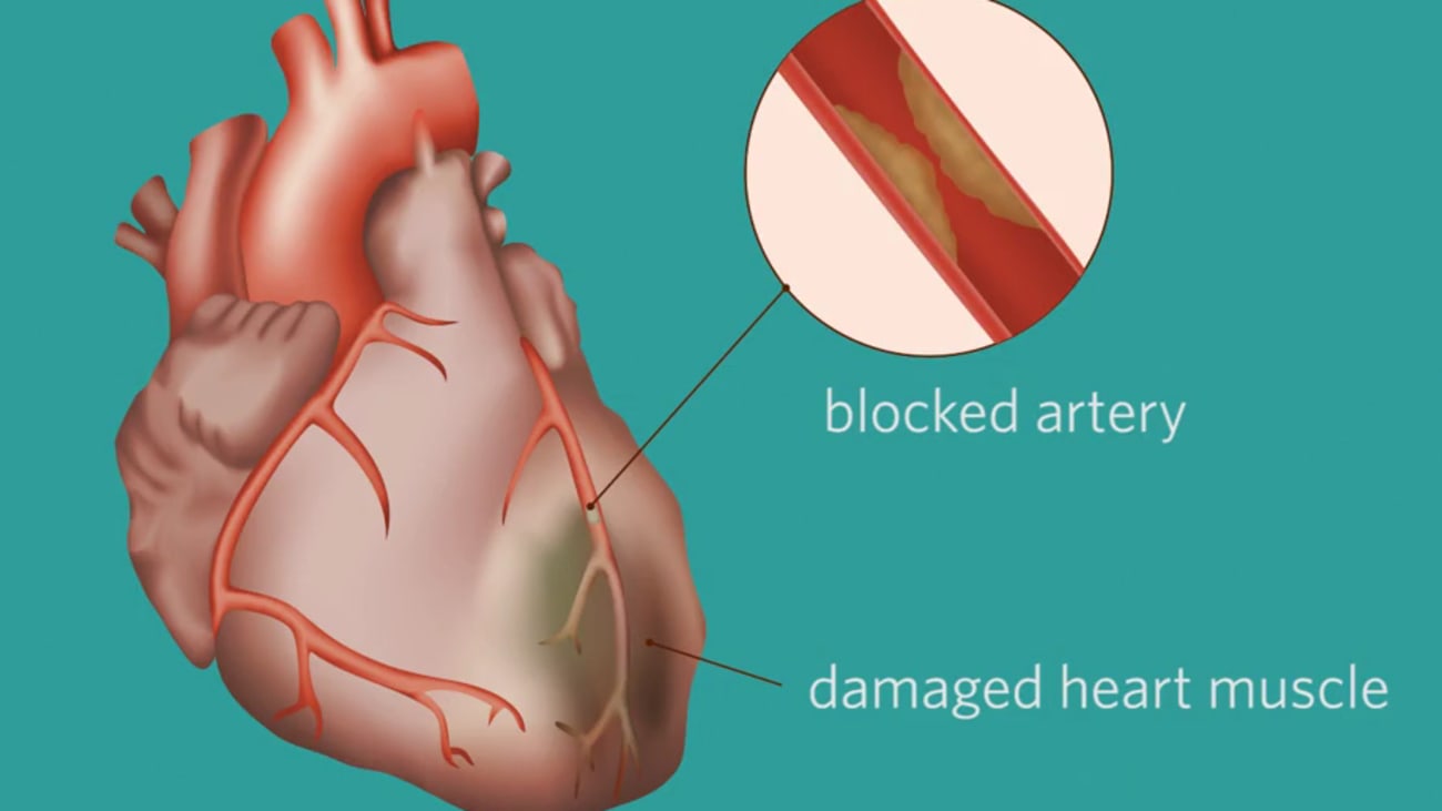 Clinical Minutes: Cardiac Catheterization