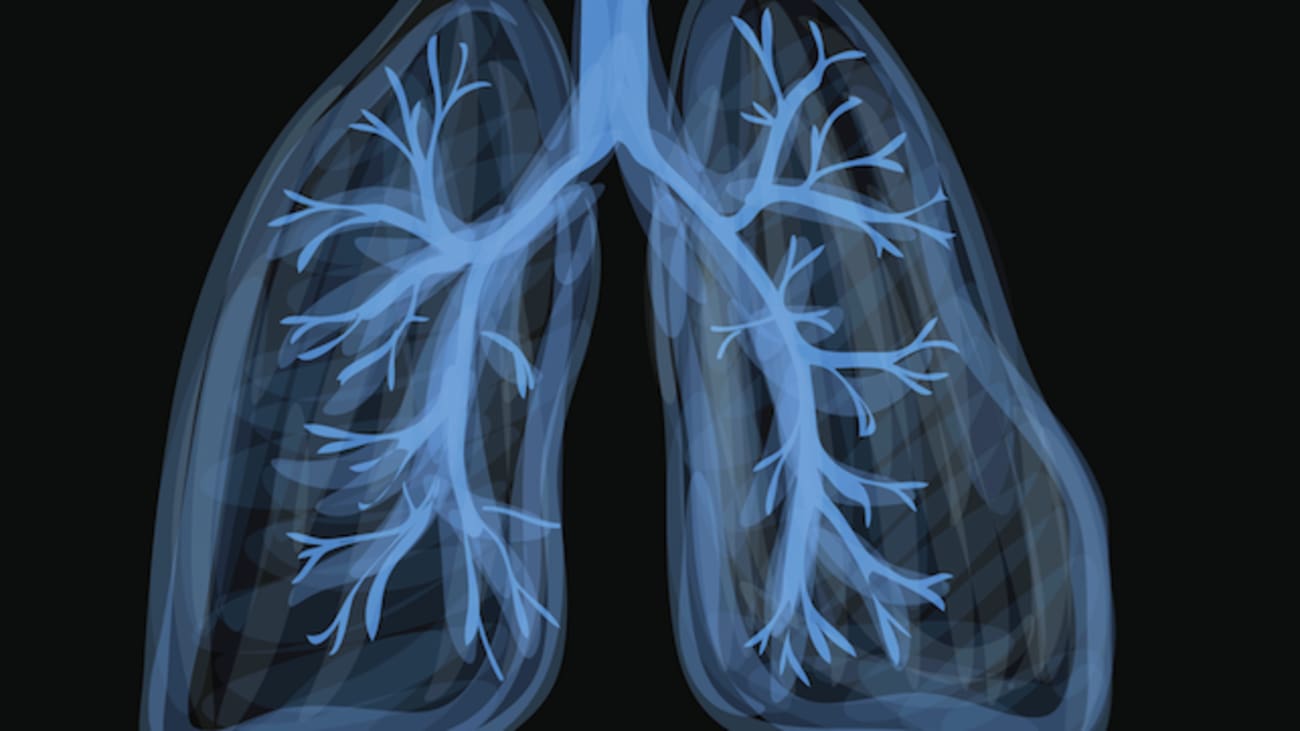 Overview of Lung Transplantation and Post-Transplant Care