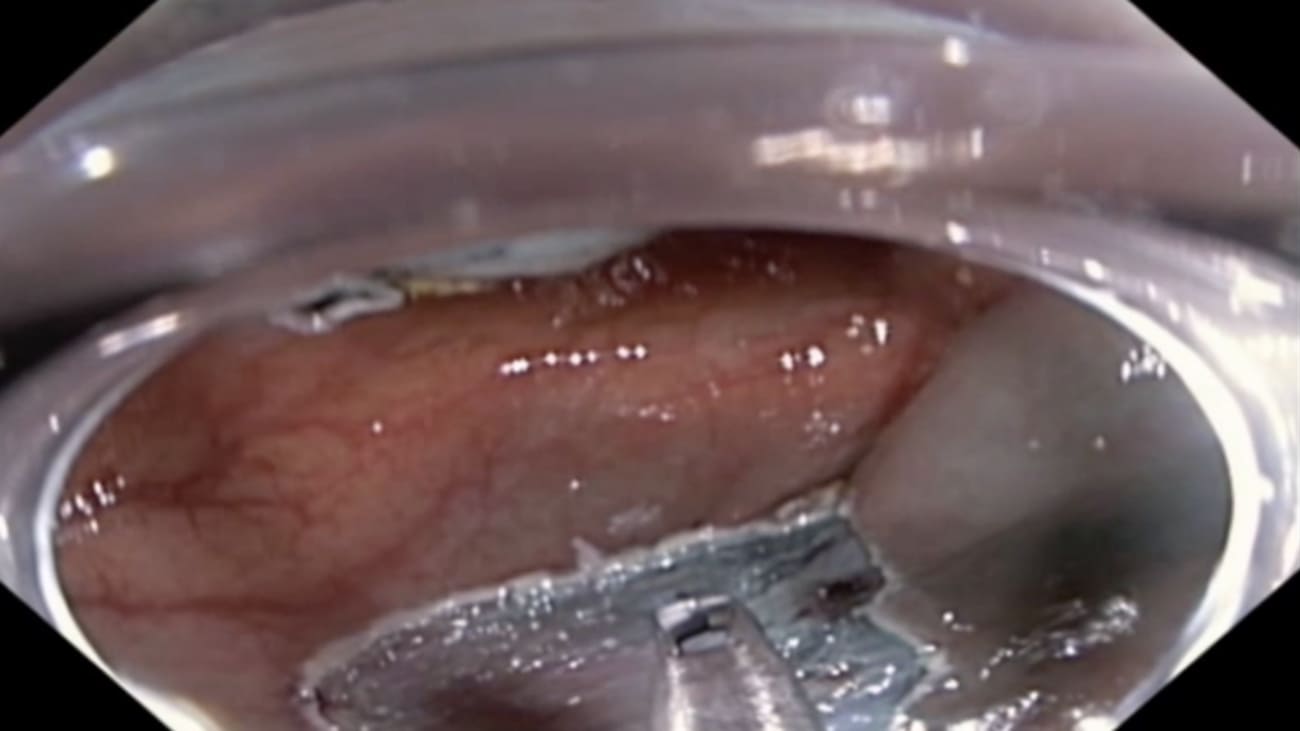 Case Study Using Rotatable Clips for Defect Closure in the Colon, by Stephen Kim, MD