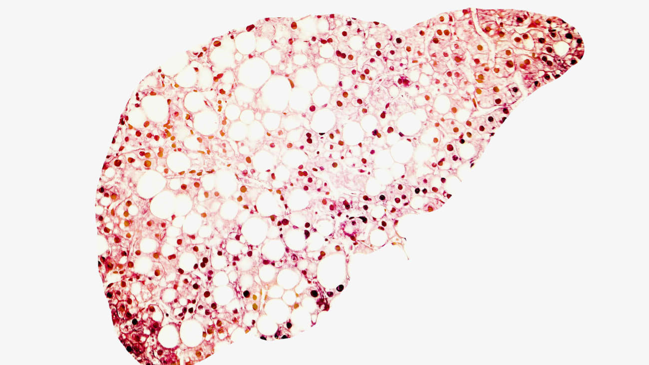 Cholestatic Liver Disease