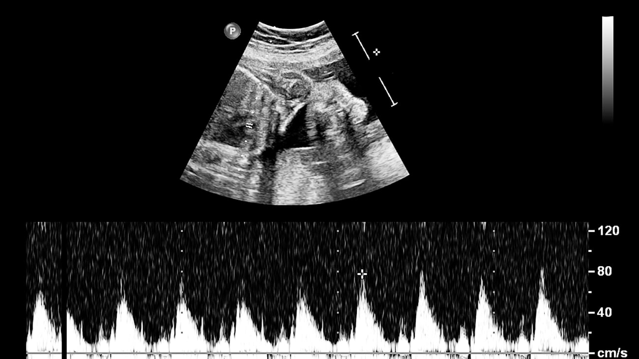 Session 1 - Non-primary cardiac disease and neurodevelopment: “It’s not the heart . . . or is it?”