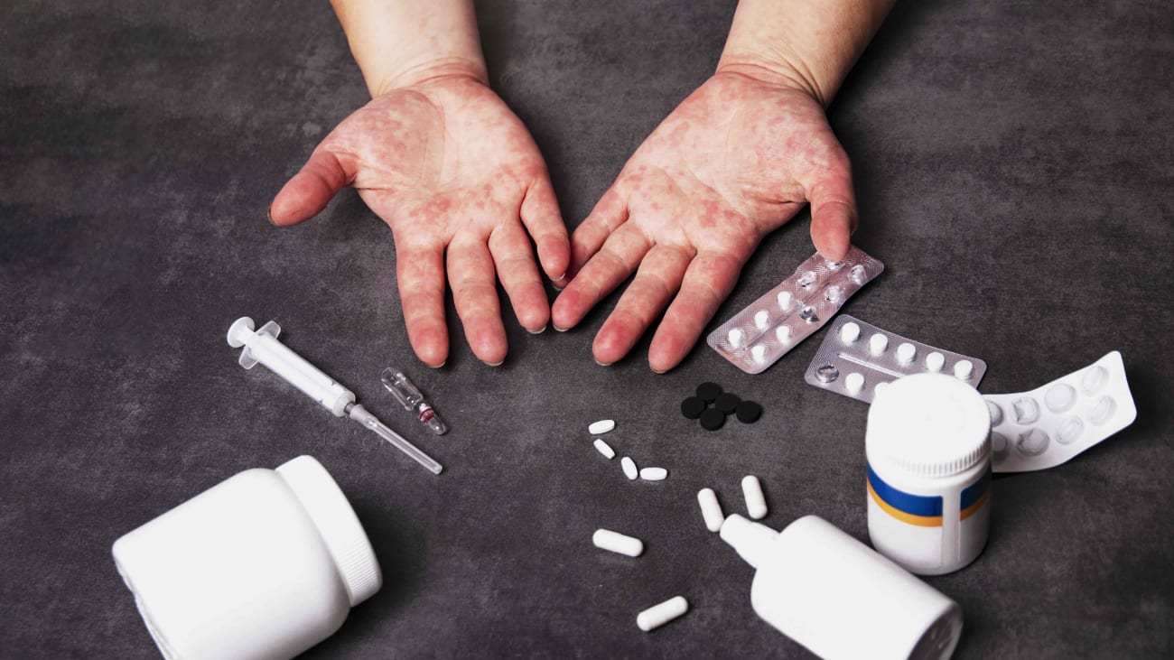 2020 Update in Internal Medicine: Approach to Common Drug Allergies 