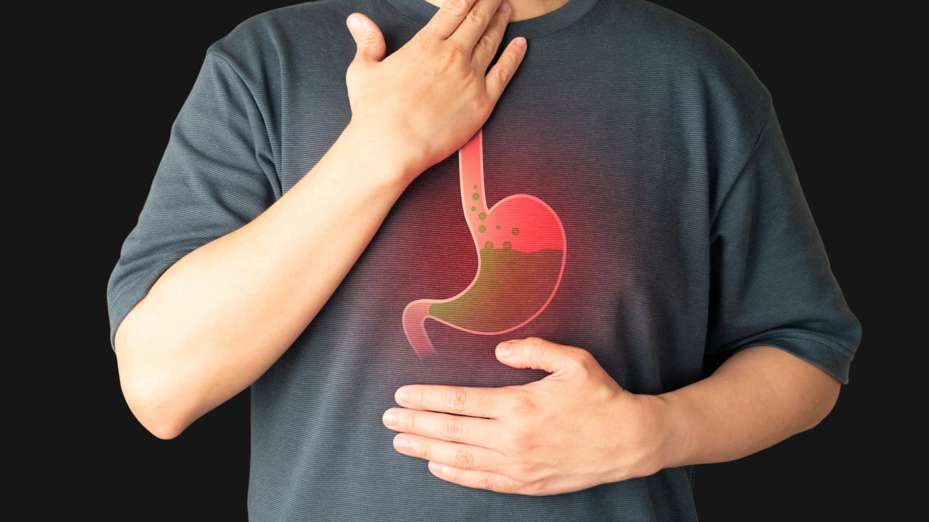 Evidence Based Endoscopy in GERD