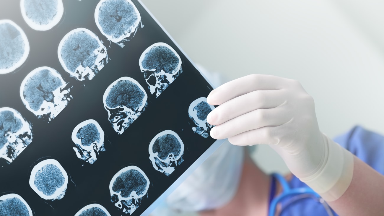 Epilepsy Care at WVU Medicine