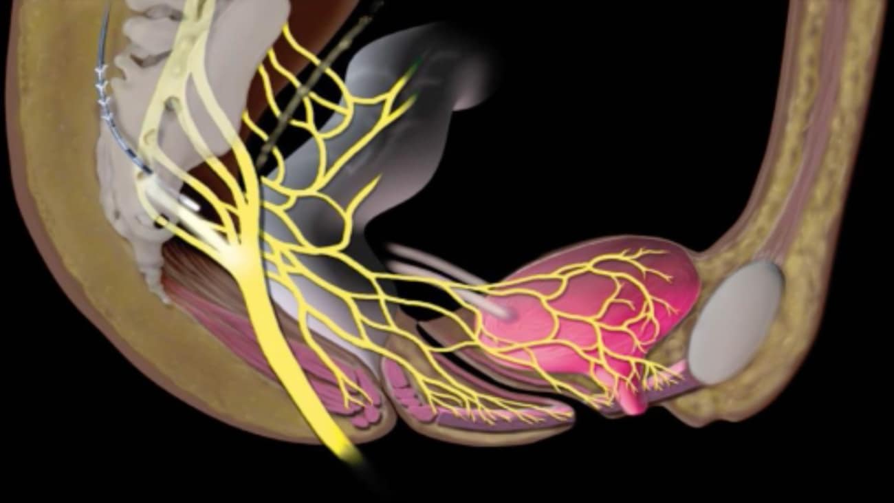 New Treatment Options for Accidental Bowel Loss