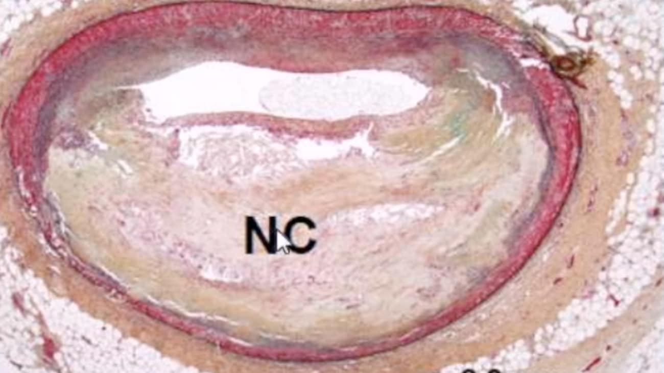 Stable Ischemic Heart Disease (SIHD)