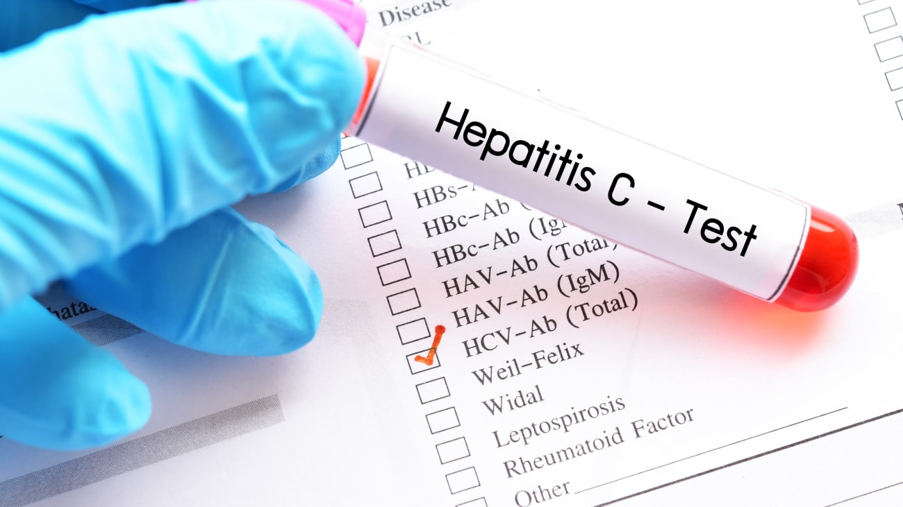 Viral Hepatitis: What Are We Doing and What Should We Be Doing? 