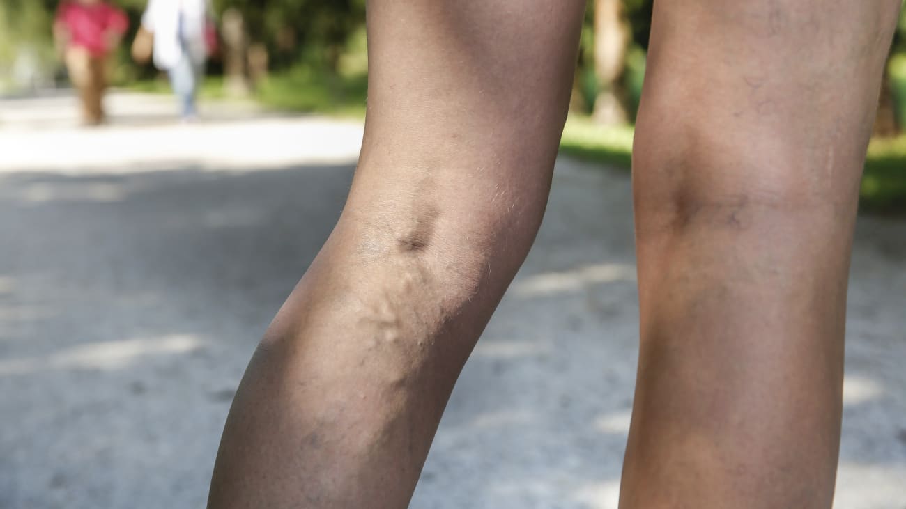 Venous Disease and Treatment Options