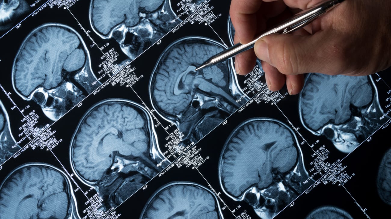 Refractory Status Epilepticus