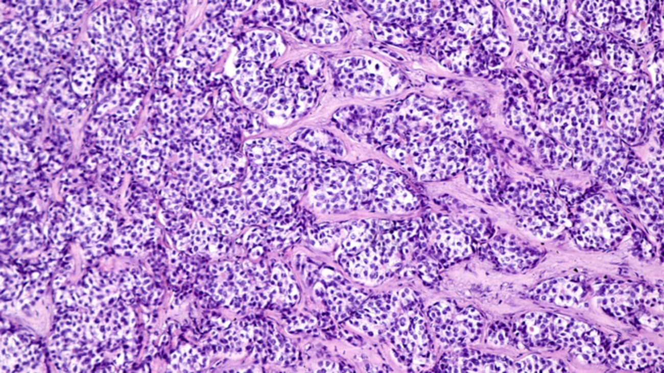 B-Catenin and Hepatocellular Cancer: From Bench to Bedside
