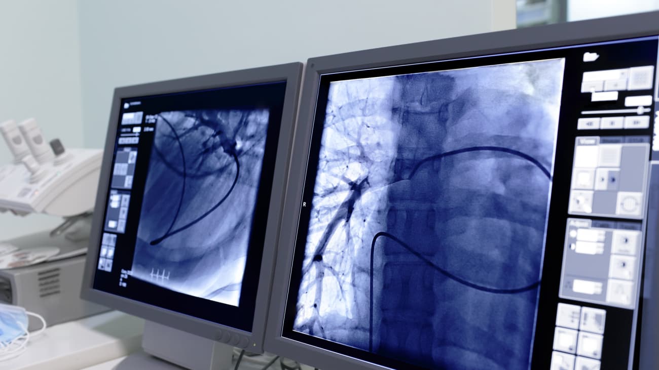 Transradial Cardiac CATH/PCI: An Update for Clinicians