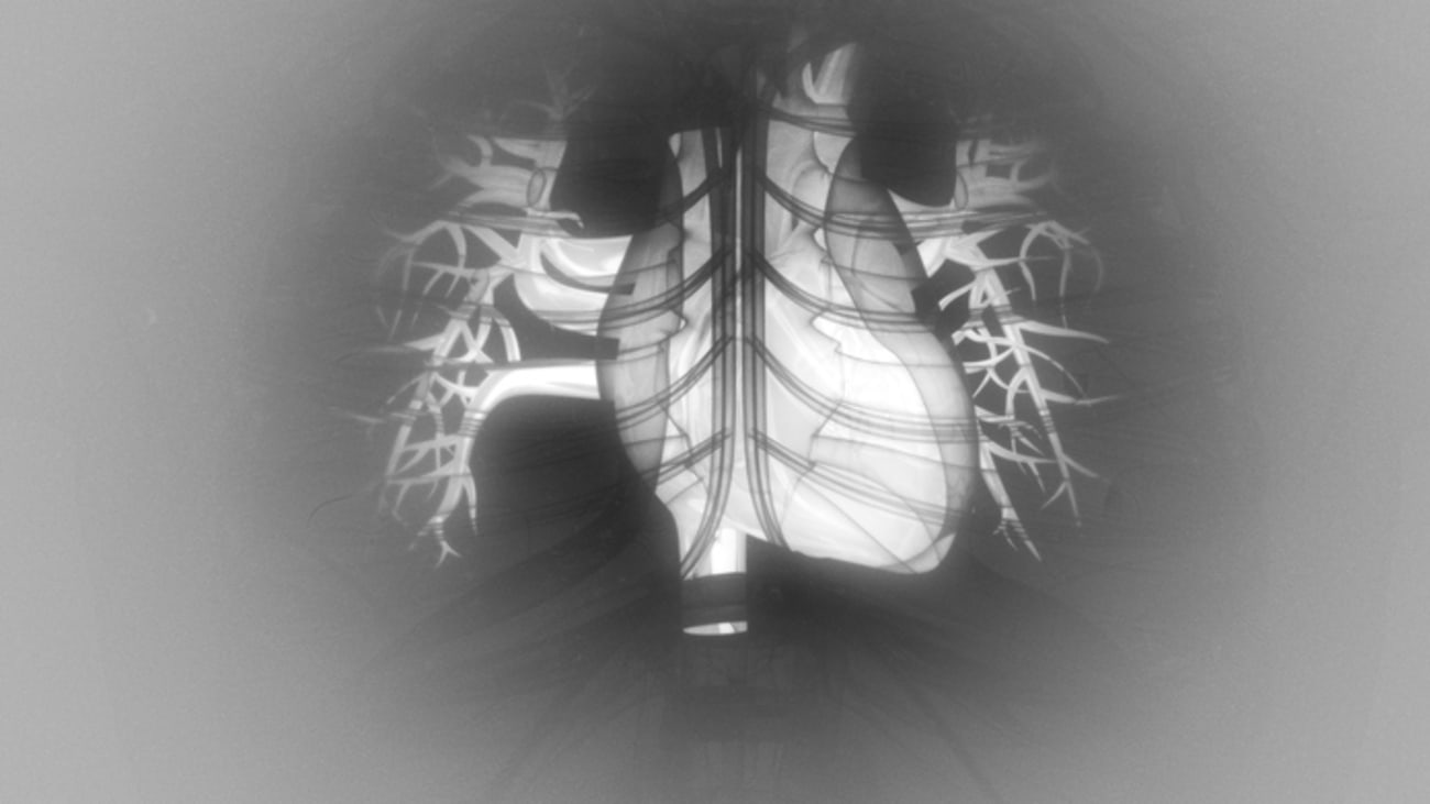 Advances in Cardiac Transplantation