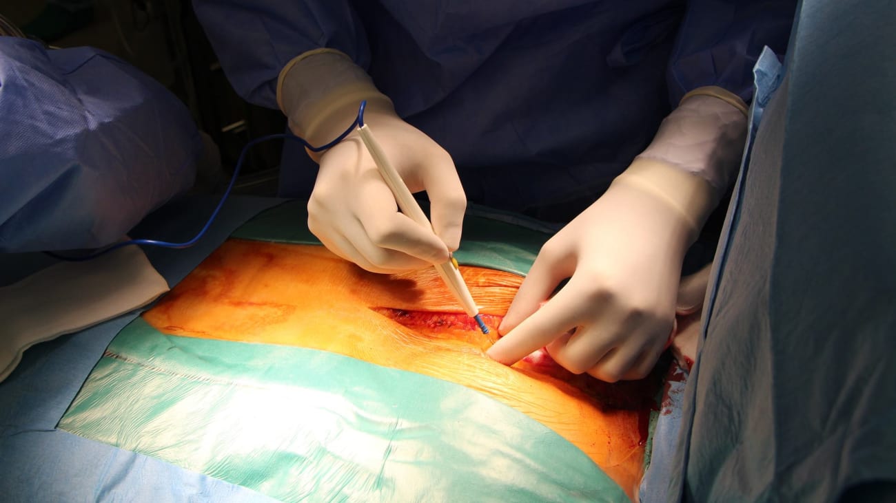 Management of the Open Abdomen: Complex Surgical Wounds and Advanced Incision Closure