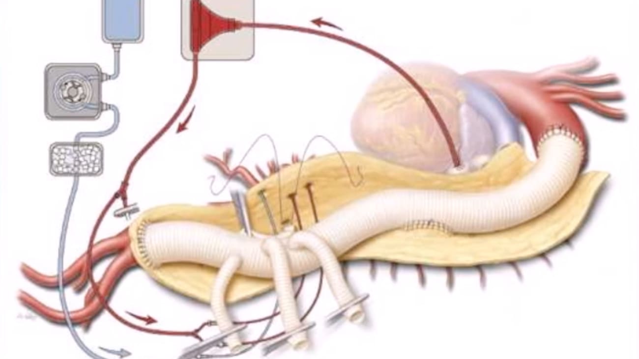 Diseases of the Aorta: Aneurysms & Dissections