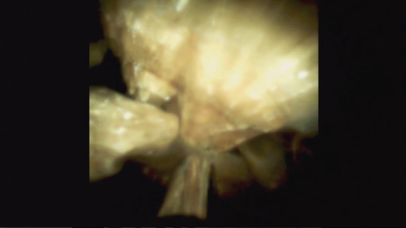 Successful Use of the SpyGlass™ DS System in Treating Mirizzi Syndrome, by Vladimir Kushnir, MD