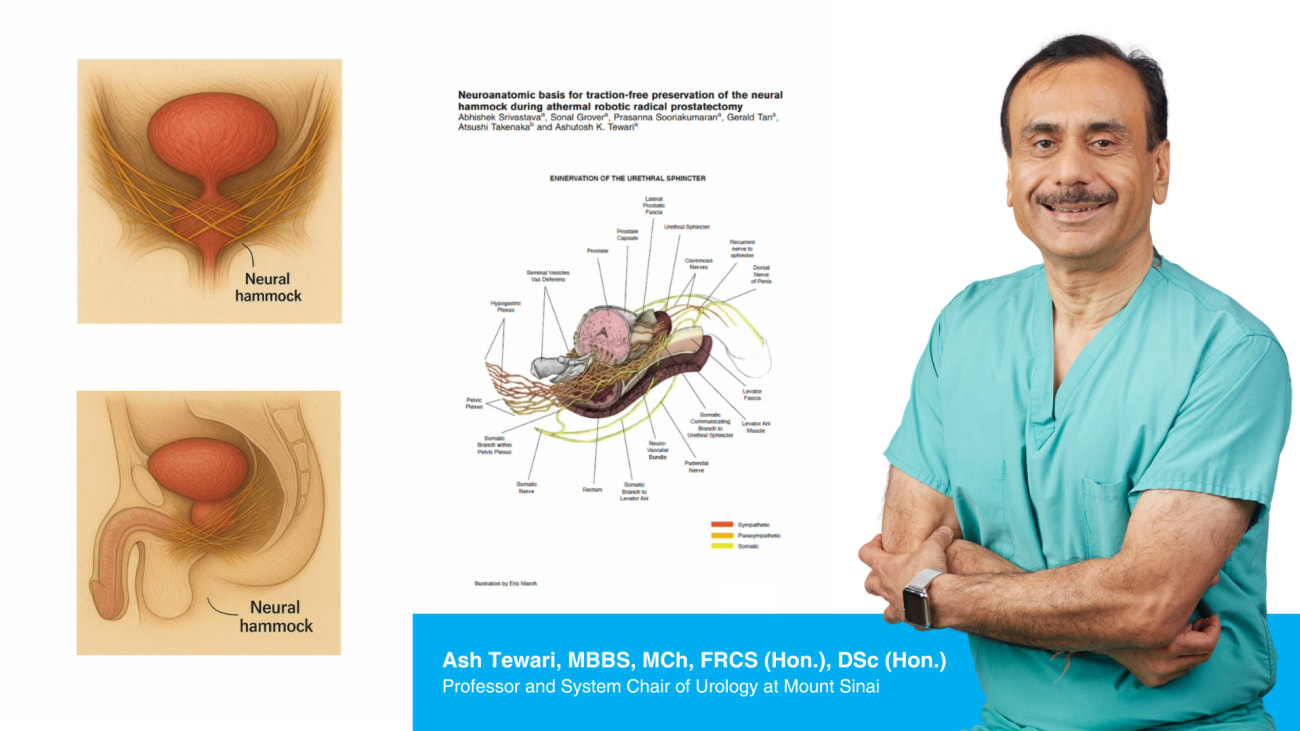 The Neural Hammock: Advancing Nerve-Sparing Robotic Prostatectomy at Mount Sinai