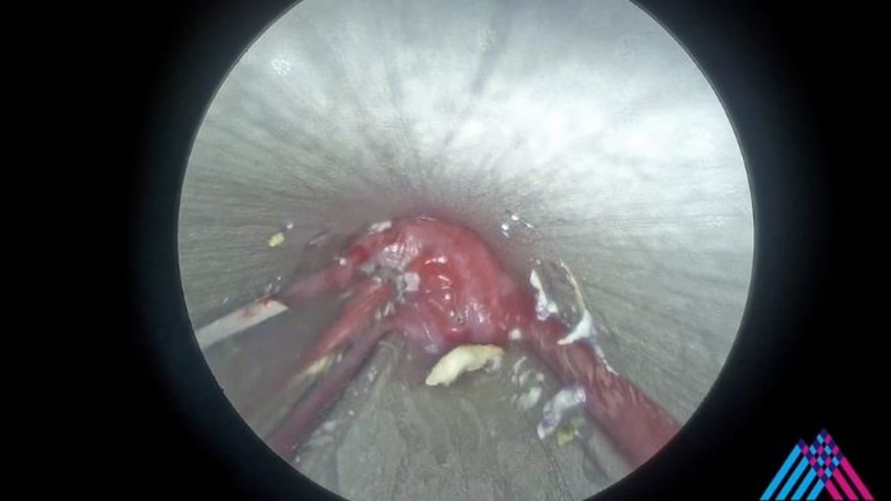 Mount Sinai Otolaryngology Surgical Series: Zenker’s Diverticulum Minimally Invasive Repair