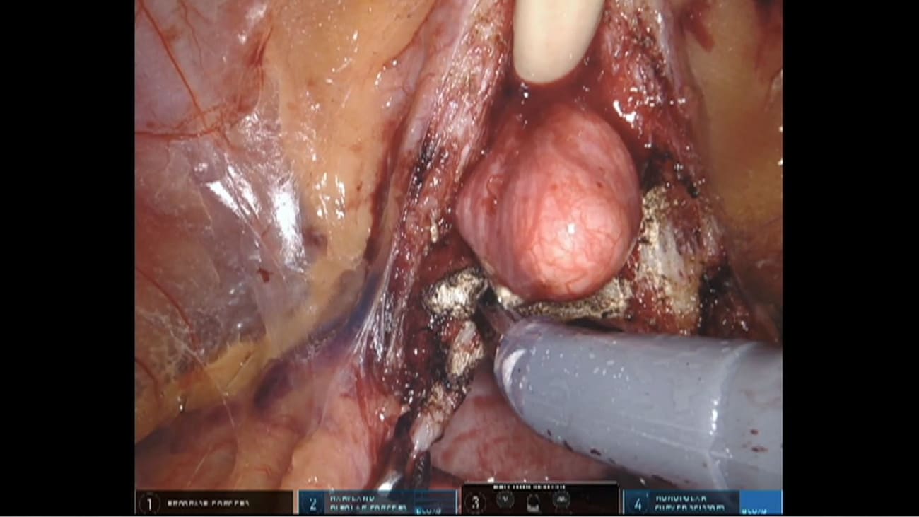 Hood Technique of Robotic Radical Prostatectomy