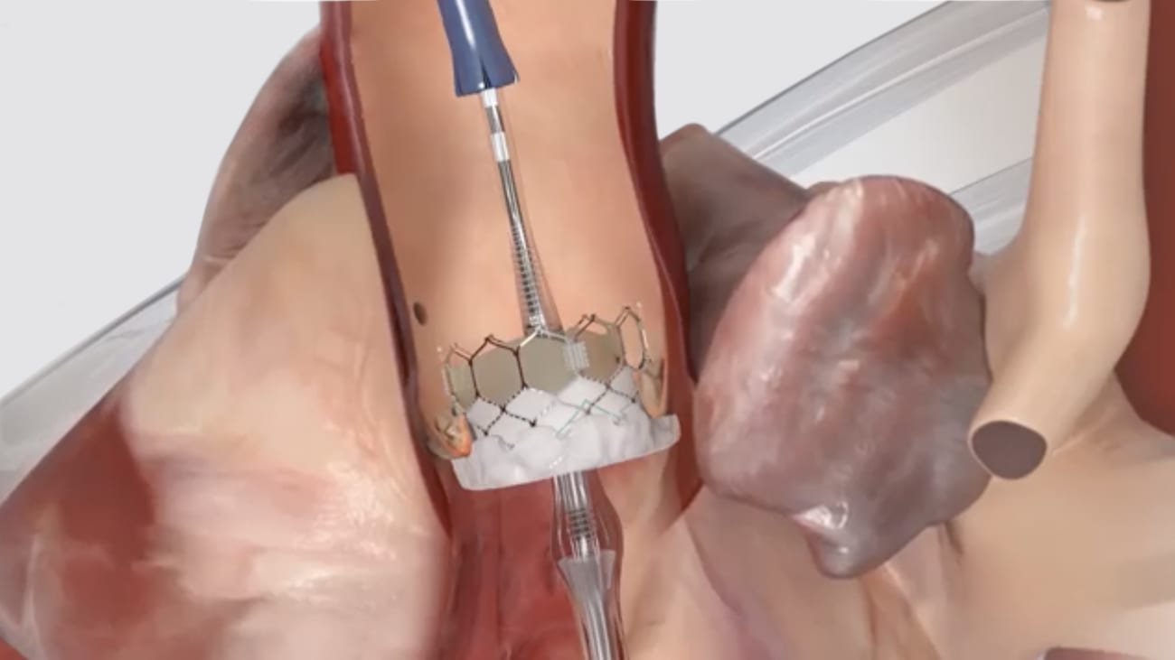 Tailoring Aortic Valve Treatments to the Patient