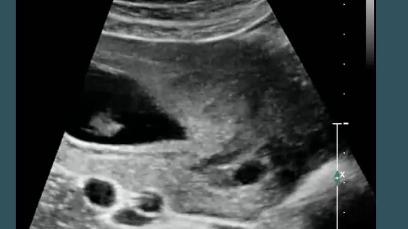 First Trimester Ultrasound: The Basics and Some Newer Concepts