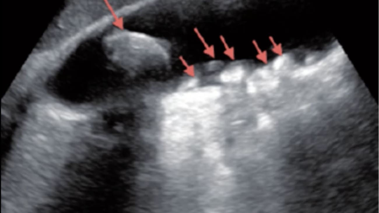 Gallstones