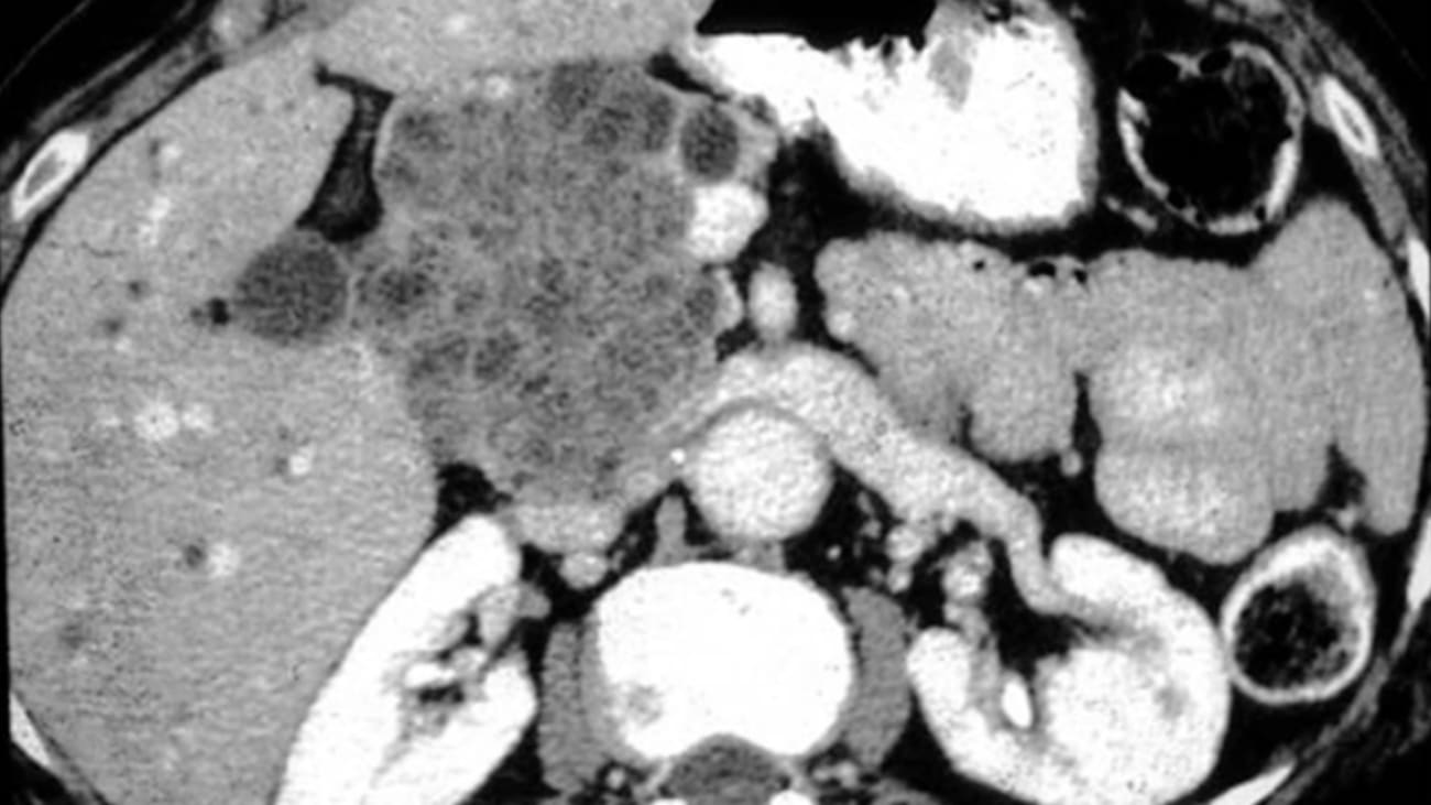 Pancreatic Neoplasia