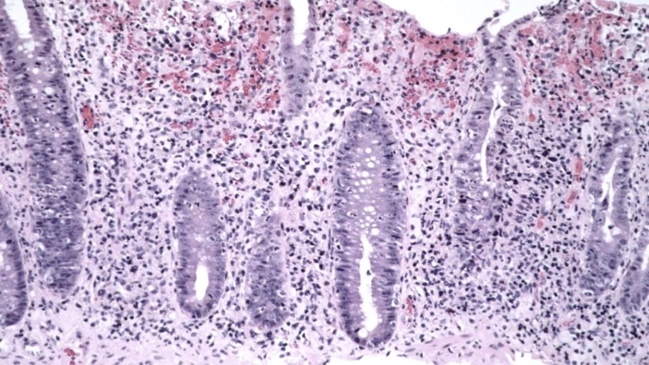 Lower GI Pathology