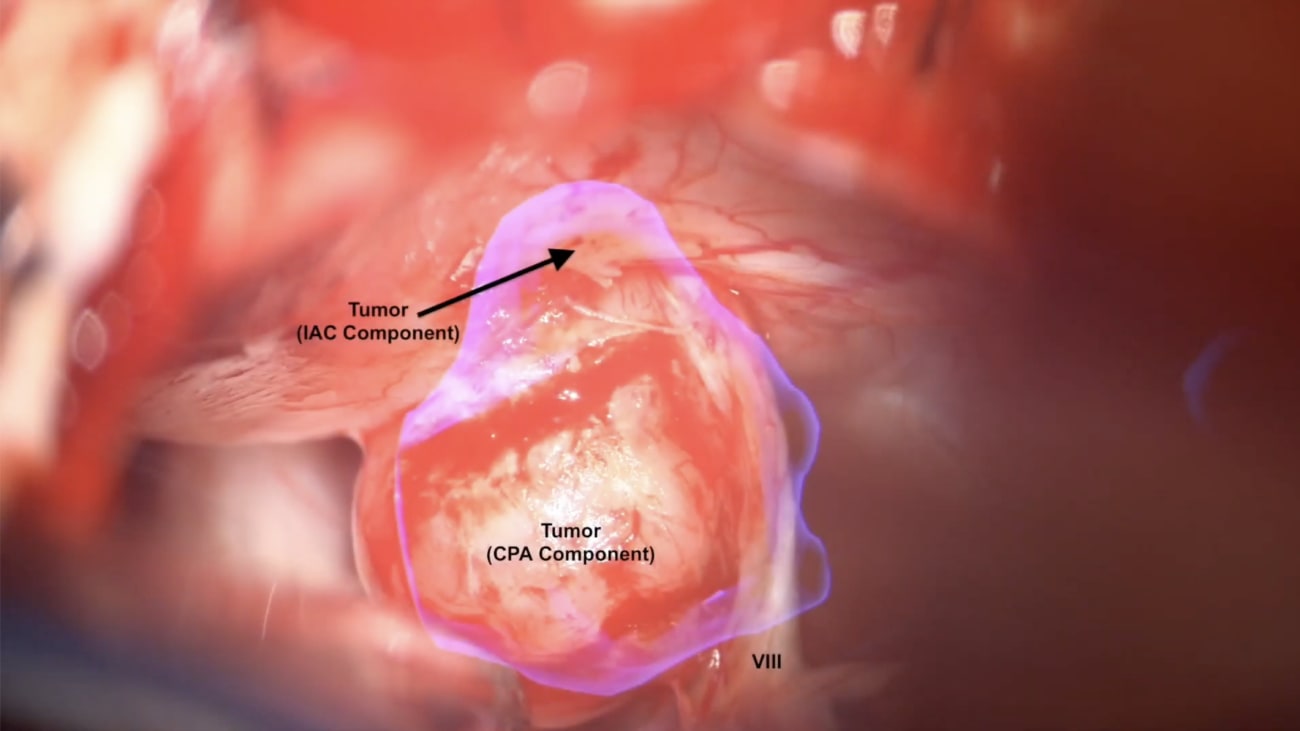 Mount Sinai Otolaryngology Surgical Series: Acoustic Neuroma/Vestibular Schwannoma Surgery: Retrosigmoid Approach