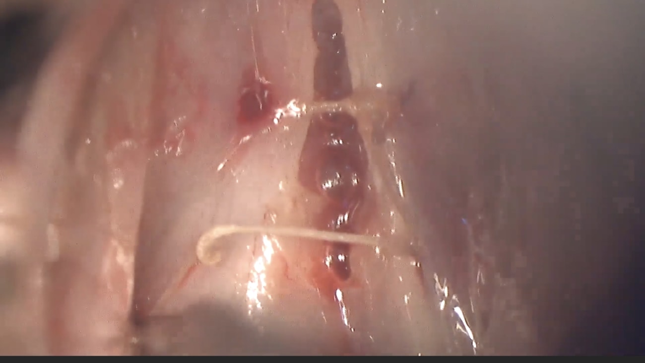 Mount Sinai Otolaryngology Surgical Series: Wendler Glottoplasty: Transgender Voice Feminization Surgery