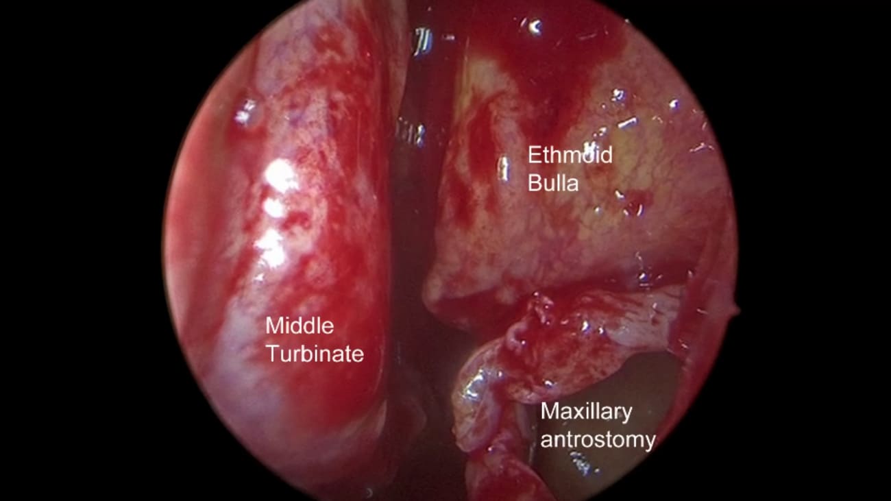 Mount Sinai Otolaryngology Surgical Series: Full Functional Endoscopic Sinus Surgery (FESS) for Sinusitis