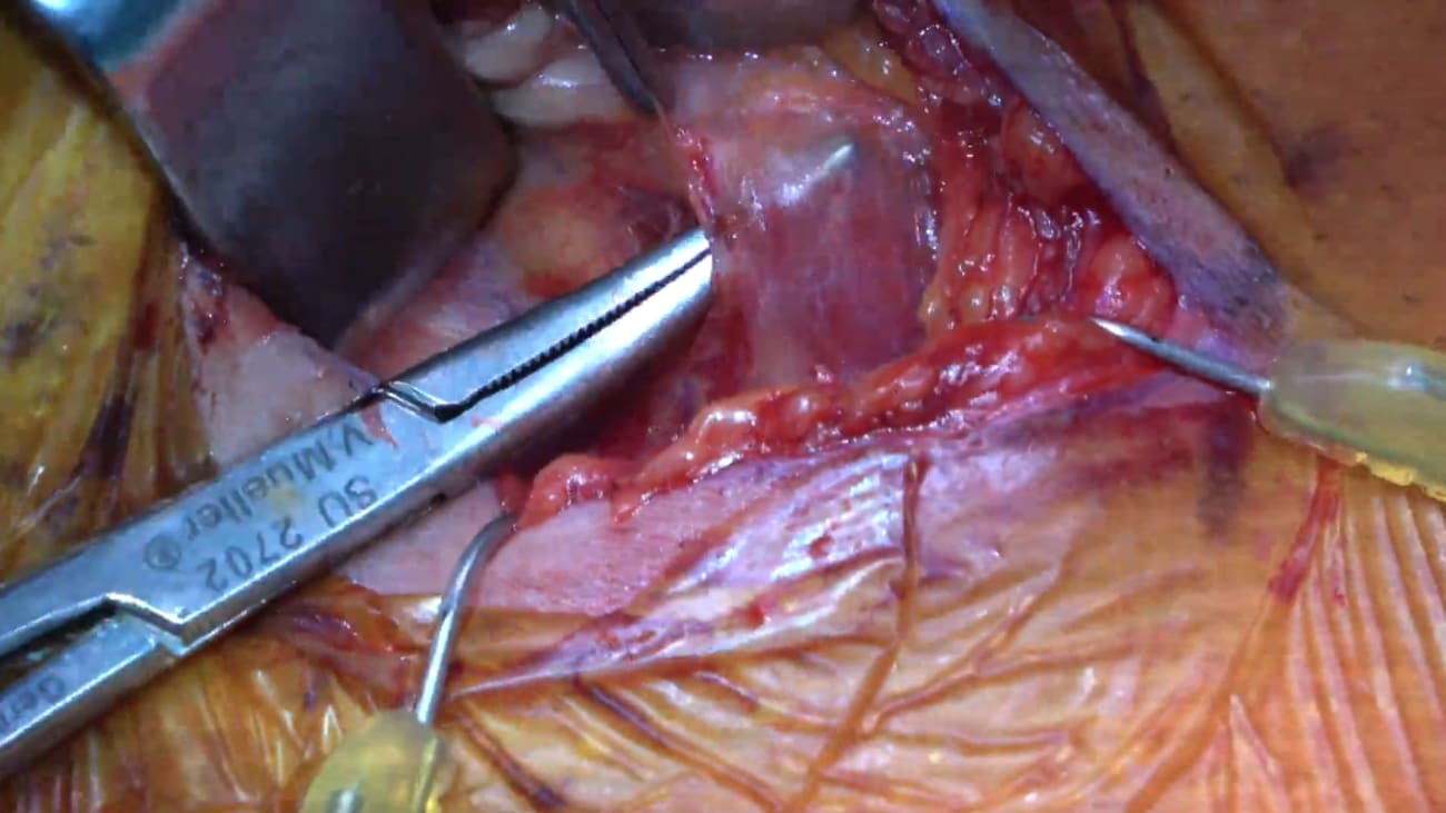 Mount Sinai Otolaryngology Surgical Series: Obstructive Sleep Apnea Surgery: Inspire Therapy Surgical Implant