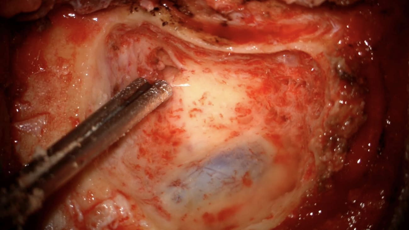 Mount Sinai Otolaryngology Surgical Series: Acoustic Neuroma/Vestibular Schwannoma Surgery: Translabyrinthine Approach