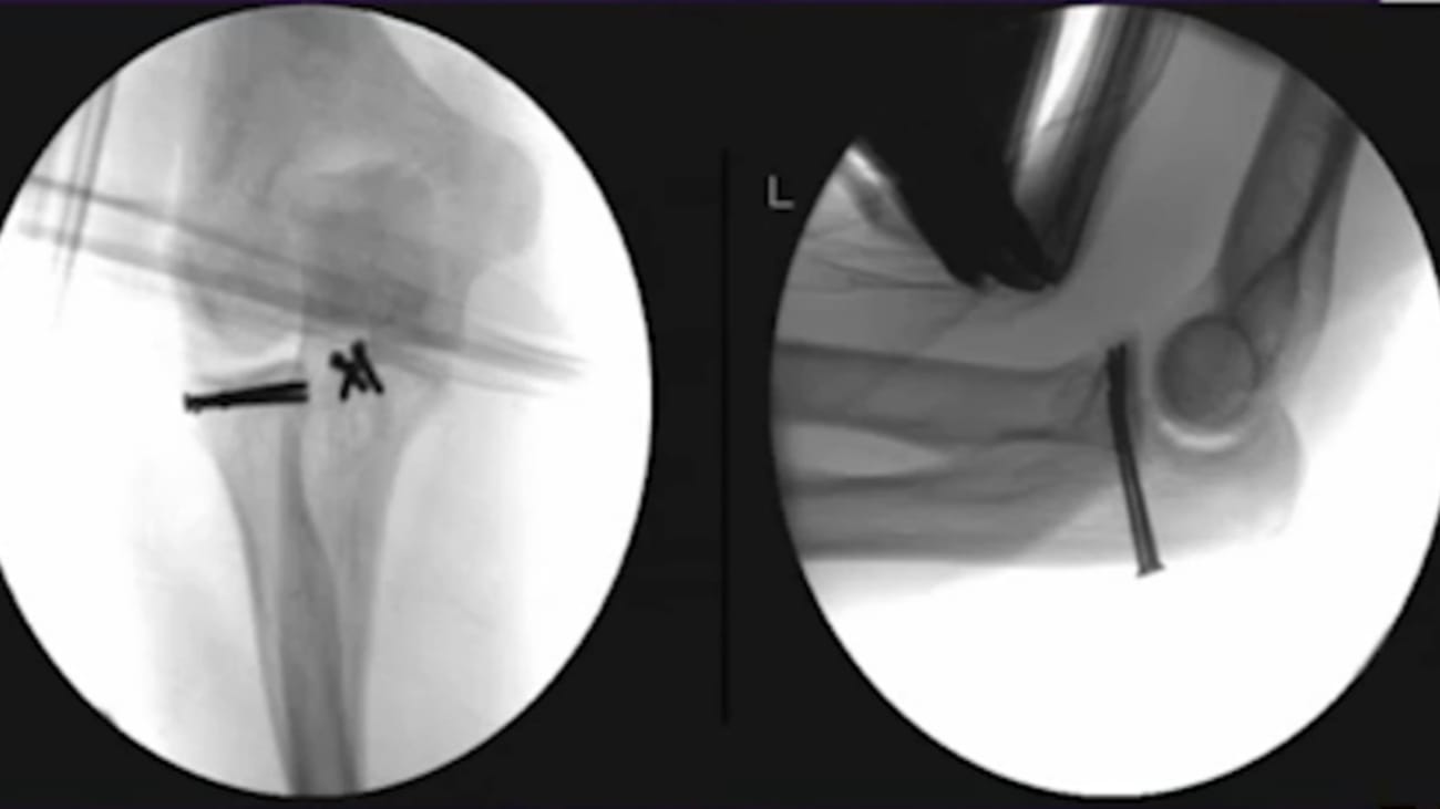 Part 2: Terrible Triad Injuries and the Complex Elbow: In a Terrible Triad, What should be fixed first?