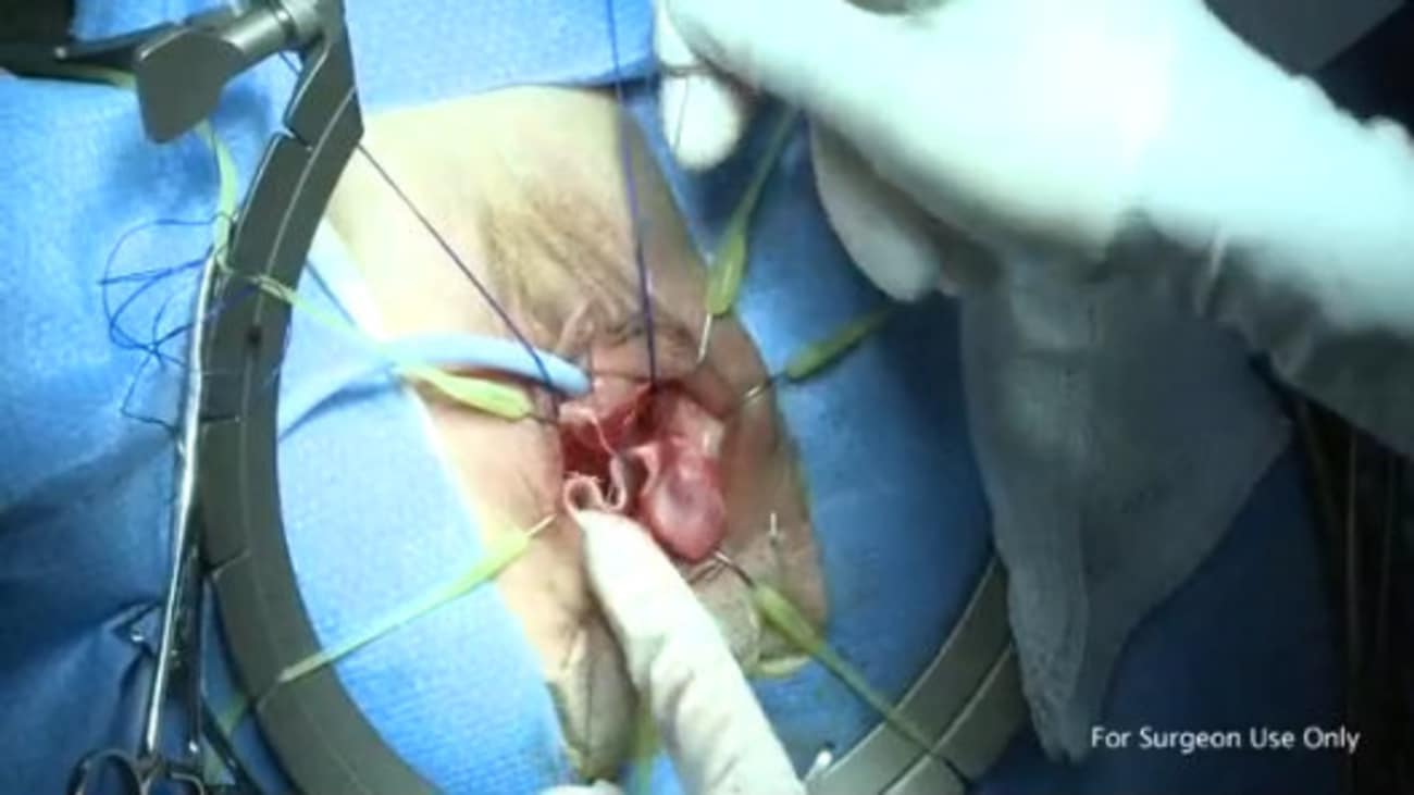 Anterior Repair with Axis® Tutoplast® Processed Dermis and Digitex® - Manish Patel, MD