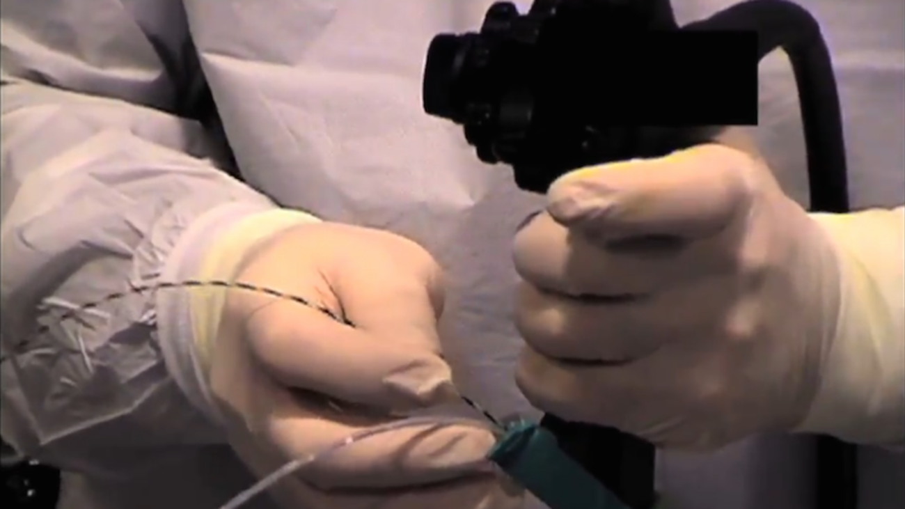 Physician Controlled Wireguided Cannulation, by Steven Edmundowicz, MD, FASGE