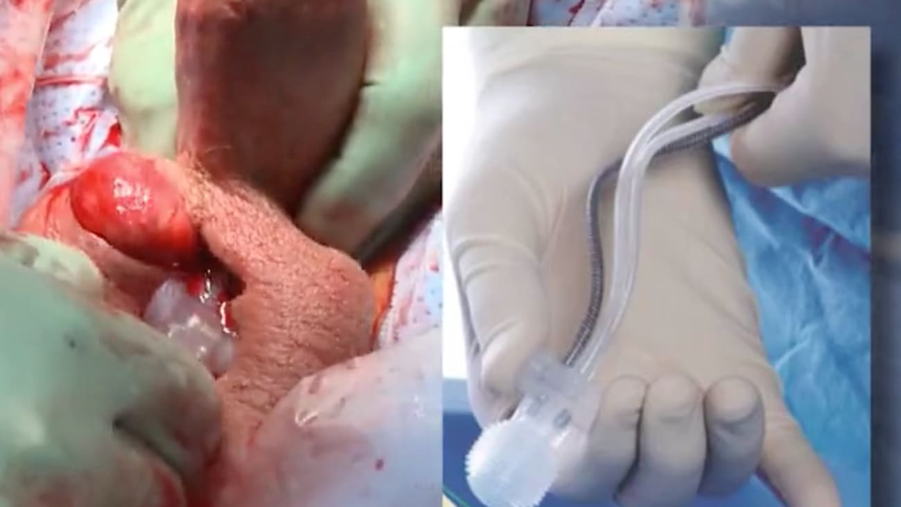 Pump Placement - Steve Wilson, MD