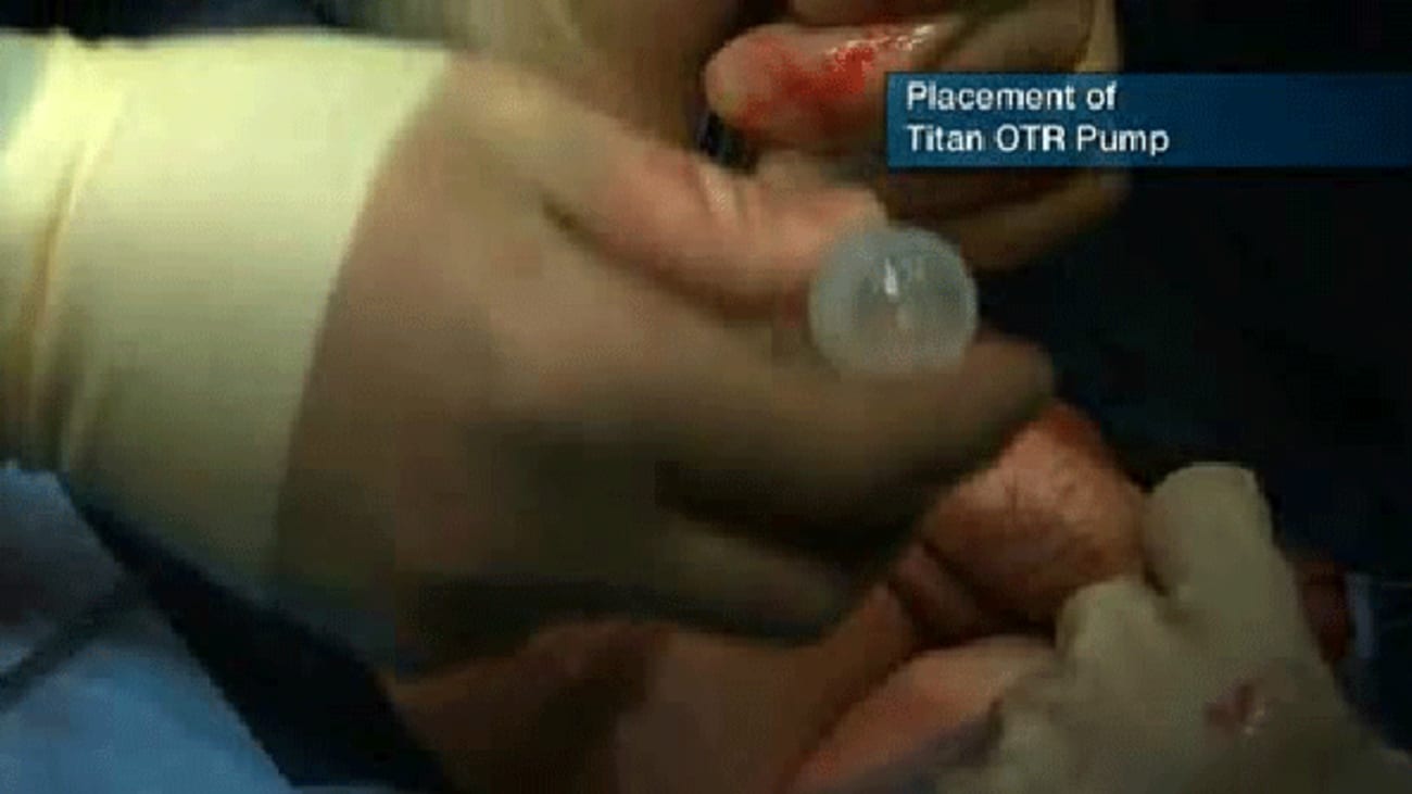 Chapter 4: Pump Insertion